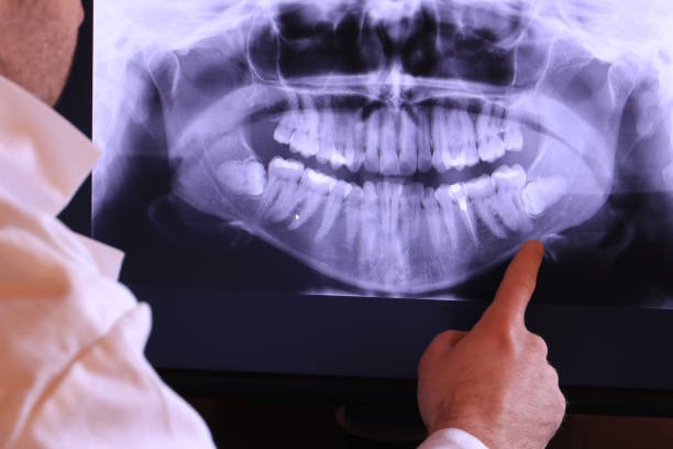 Best Emergency Wisdom Teeth Removal in Yorkville, WI
